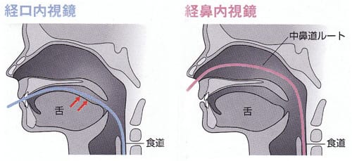 経口内視鏡 経鼻内視鏡